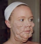 leper.jpg