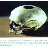 Trepanation-jpeg.jpg