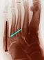 jones_fracture.JPG